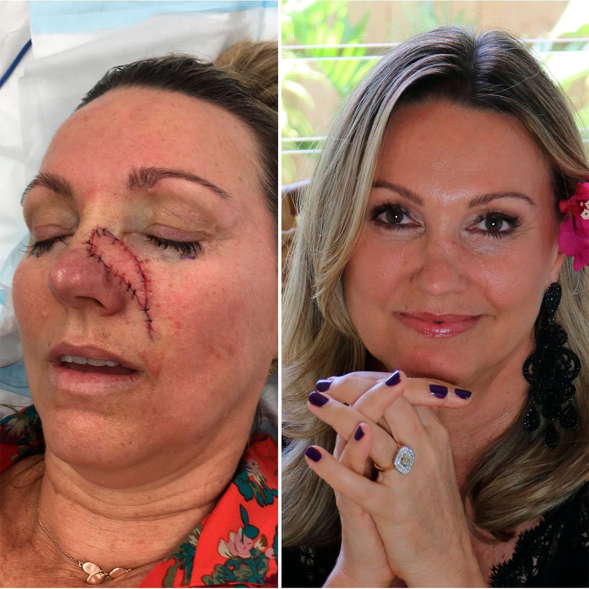 Removing the reminder