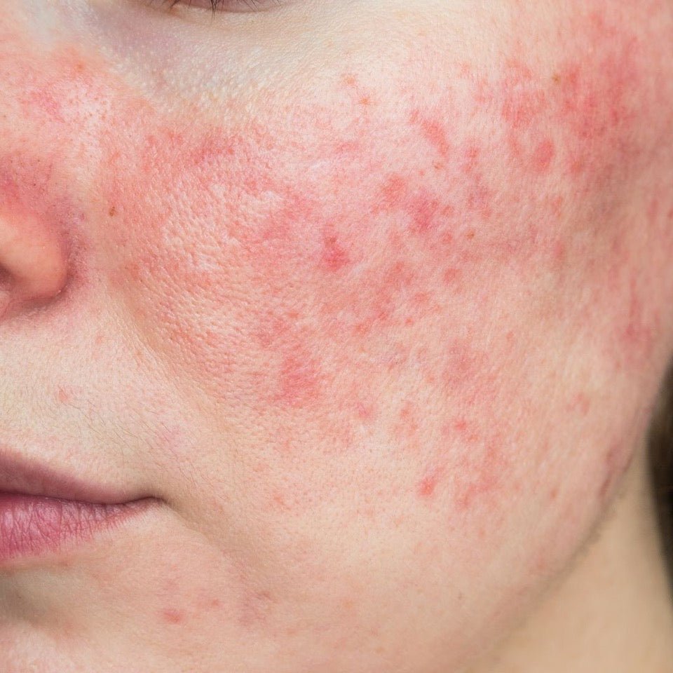 What’s your problem: Rosacea