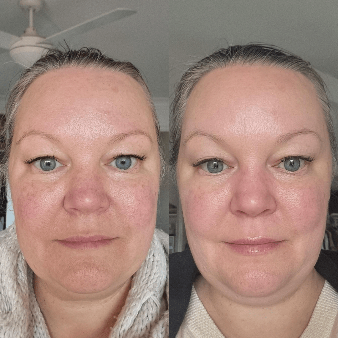 Serum Of Clear natural serum before after results on face for pigmentation and evening skin tone