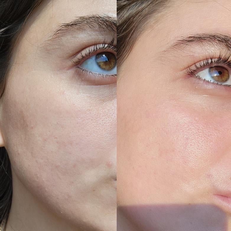 Serum Of Clear before after result smoothing brightening treatment