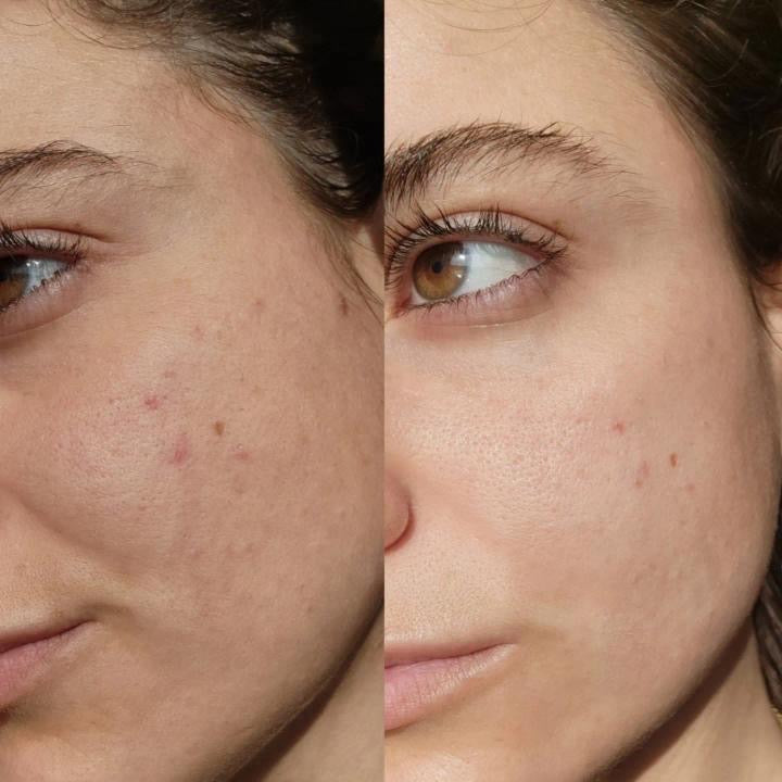 Comparison of a woman's face with acne on the left side and clear skin on the right side. Before and after using Serum of Clear