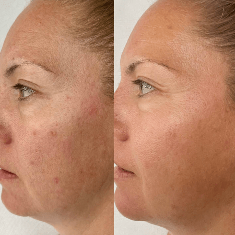 Serum Of Plenty natural vitamin c before after results