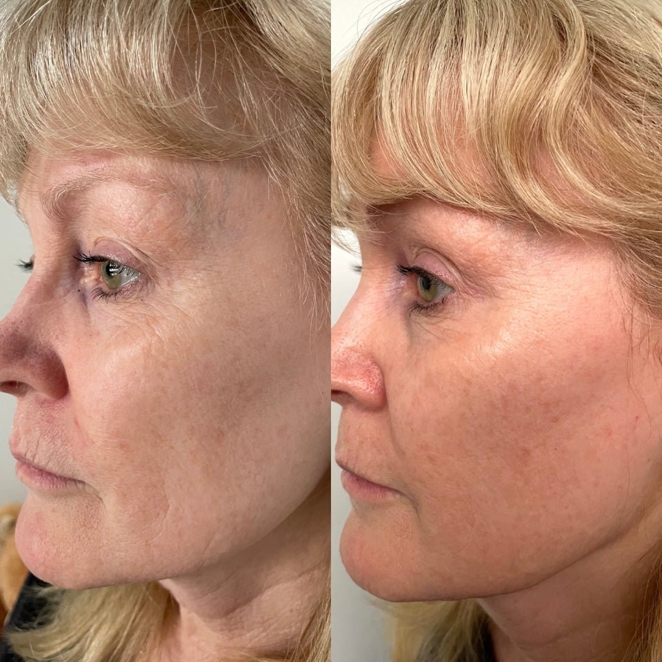 Serum Of Plenty vitamin C brightening tightening skin treatment before after result