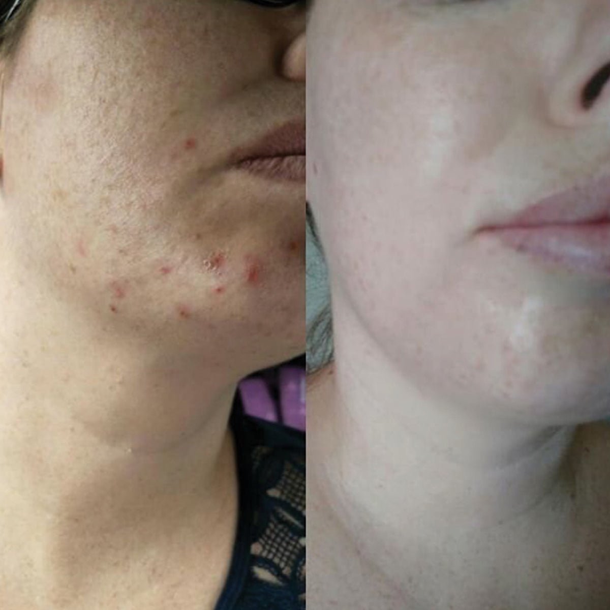 Before and after results of Super Citrus Cleanser on acne dry skin